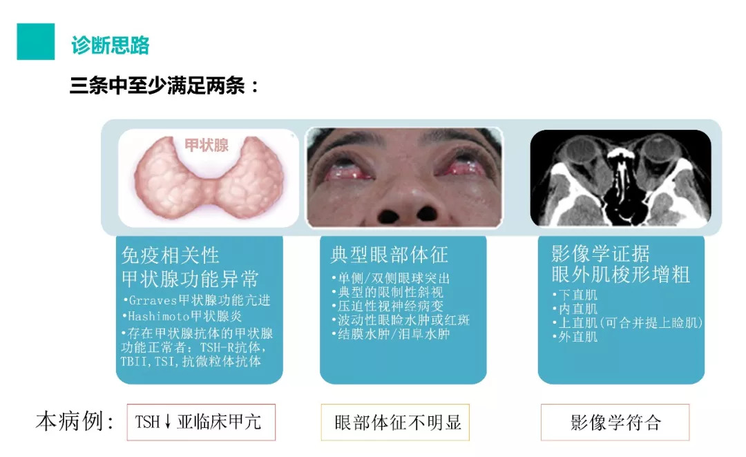 甲状腺相关眼病的科普,甲状腺眼病的临床表现