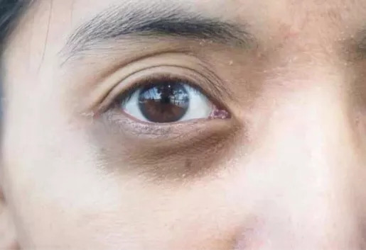 黑眼圈一直去不掉有其它原因吗,十几年黑眼圈去不掉是怎么回事