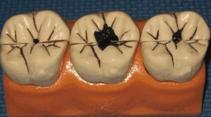 虫牙是虫子引起的吗,虫牙真的是被虫子吃掉的吗