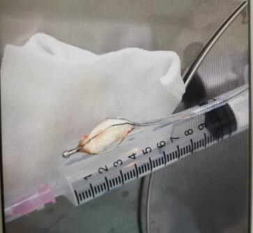 八旬老人久咳不愈,老年人咳嗽咽喉有痰卡住气喘