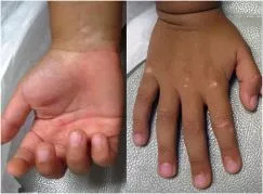 “长期玩水彩笔诱发白癜风的案例已经不止这一个了”