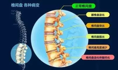 腰椎间盘突出贴膏药要贴多久治愈 (腰椎间盘突出脚麻贴膏药有效果吗)