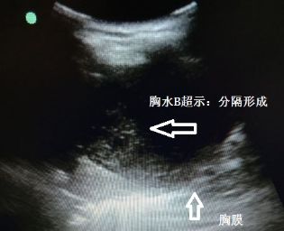 胸水抽了为什么还呼吸困难,胸水抽不出来了怎么回事