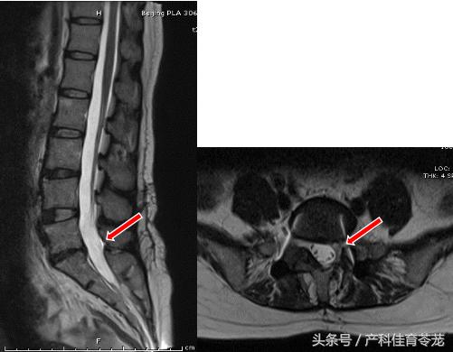 椎间盘突出如何保养防复发,椎间盘突出手术复发后中医治疗