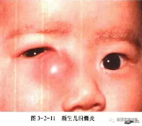 宝宝眼屎多是上火吗,白眼屎是寒气还是上火