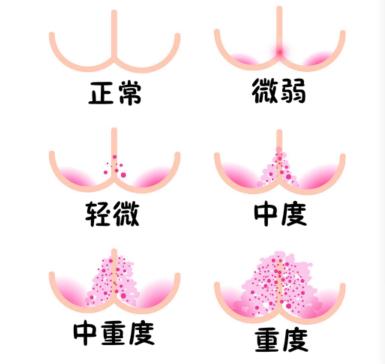 宝宝屁股尿布疹红脱皮,尿布皮炎就是红屁股吗