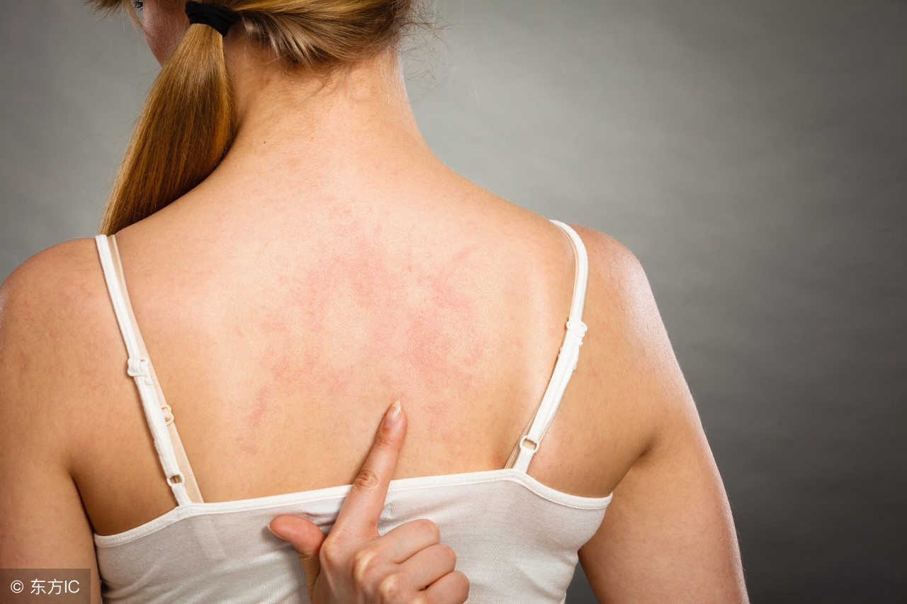 了解一下宝宝湿疹的症状,腹股沟湿疹的症状及治疗方法