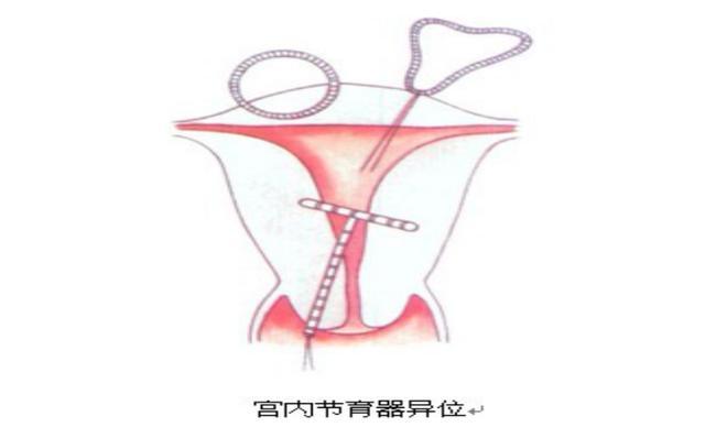 带环月经推迟6天没怀孕,带环一个月不来月经会怀孕吗