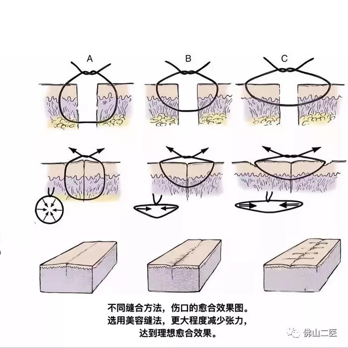 疤痕没那么可怕找对方法即可淡疤,有疤痕的你还在为疤痕烦恼吗