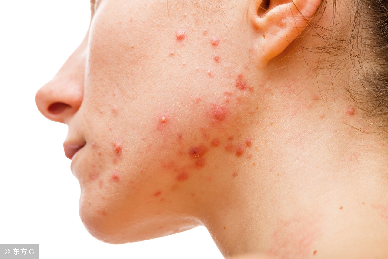 脸上长几个痘可以吃异维a酸吗,异维a酸爆痘期能不能用中药调理