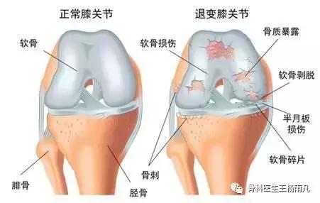 最新的人工膝关节使用寿命,膝关节使用说明