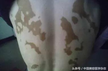 皮肤原位再生医疗技术联合微针导入治疗白癜风