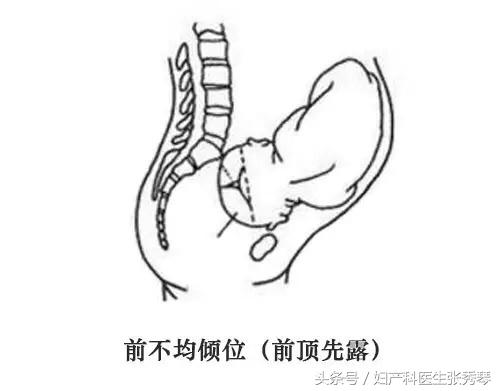 孕晚期时出现胎位不正要怎么应对,孕晚期胎位不正的常见原因