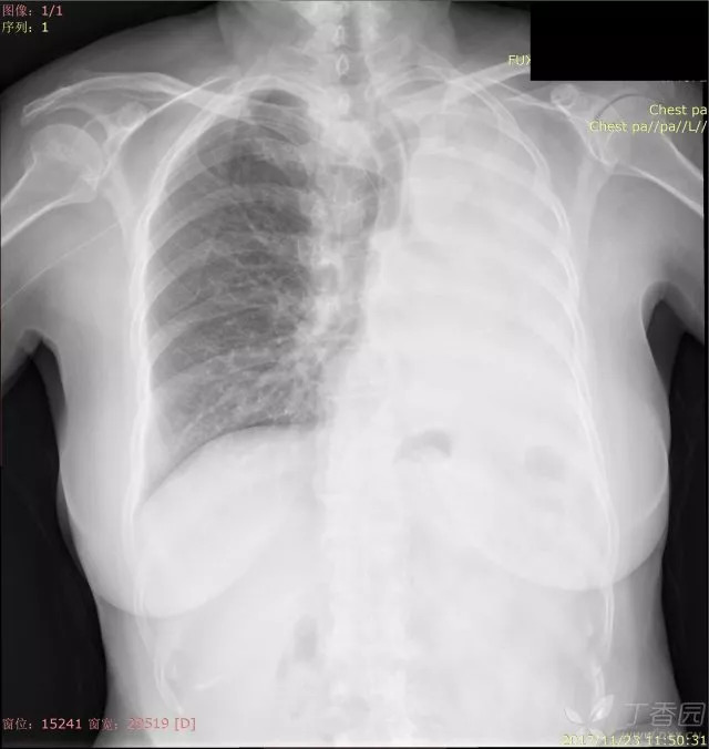 又见白肺，一文教你如何跟患者讲解平片，收藏！