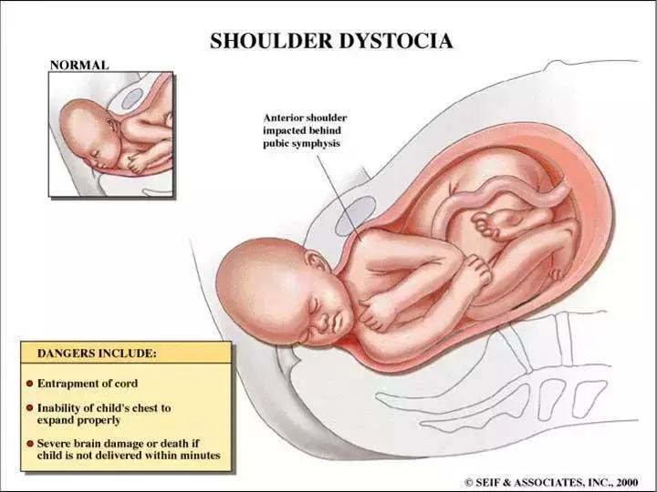 顺产宝宝的头被卡住了,顺产胎头卡在骨盆那是什么原因