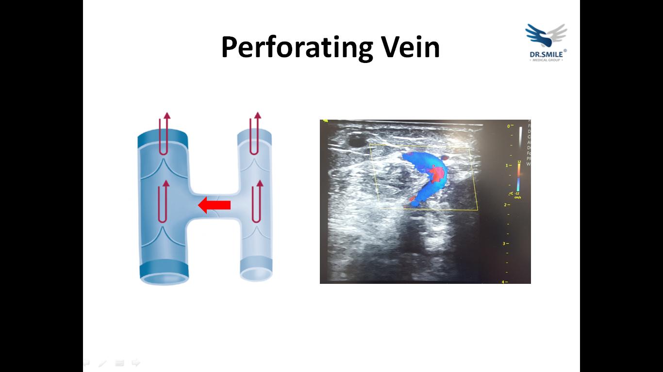 静脉曲张详细解说,静脉曲张知识大全书籍
