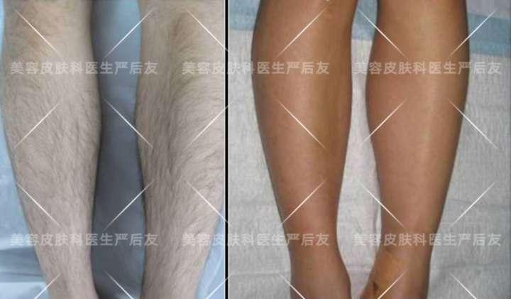 上海面部激光脱毛,正确认识皮肤