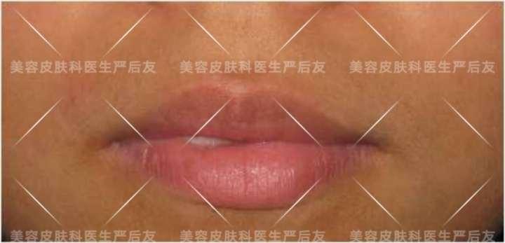 上海面部激光脱毛,正确认识皮肤