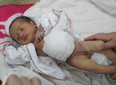 3个月宝宝疝气哭闹怎么办,新生儿腹股沟疝气护理知识