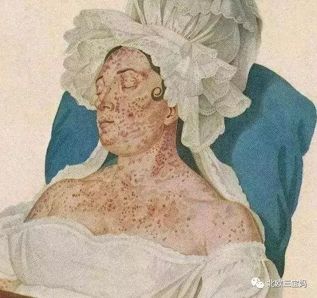 怎么分辨宝宝热疹湿疹荨麻疹,幼儿急疹和湿疹风疹有什么区别