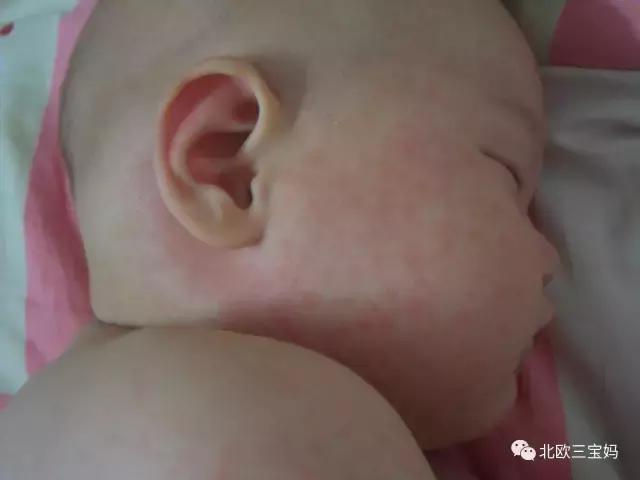 儿童急疹科普,宝宝湿疹和热疹的正确护理方法