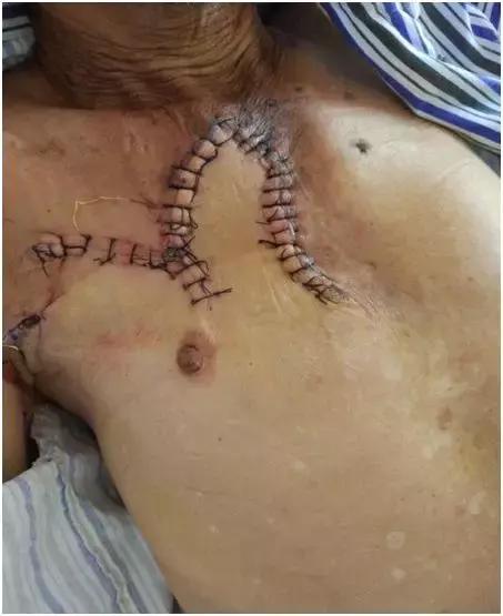 外二科手术,外二科手术流程