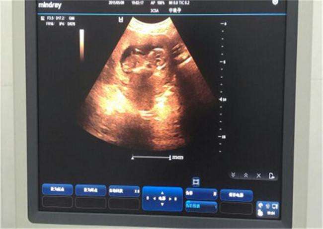 怀孕3个月胎儿趴着怎么办,三个月胎儿趴肚子里视频