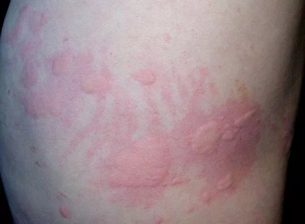 挠痒起风团,过敏性荨麻疹太刺挠了怎么办