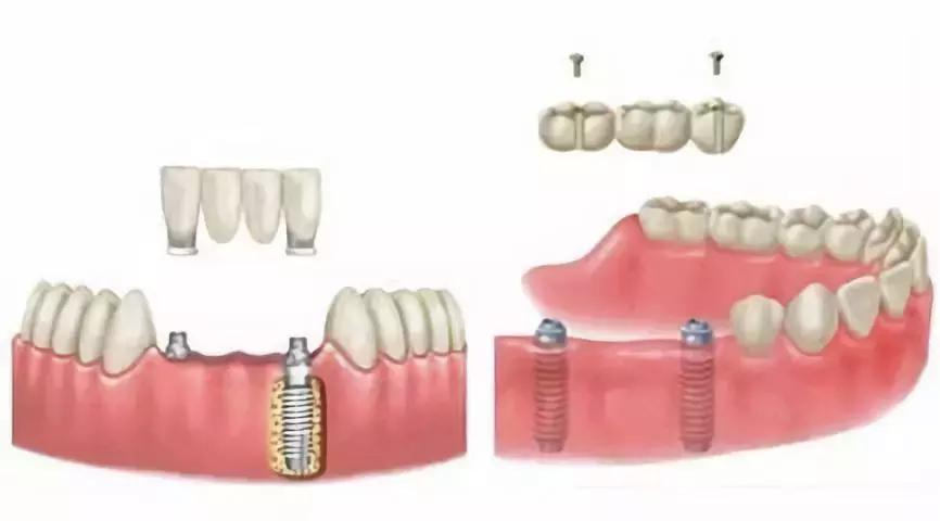 为什么会牙列缺失,口腔牙列缺失患者情况