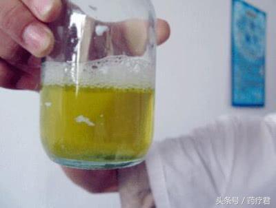 尿中有少量的絮状物是怎么回事,尿中絮状悬浮物是什么