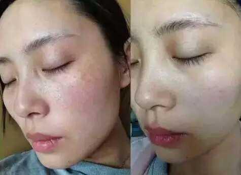 消除褐斑的最佳方法,去褐斑自愈的最佳方法