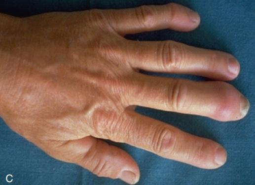 银屑病关节炎和银屑病区别,银屑病关节炎跟银屑病一样吗