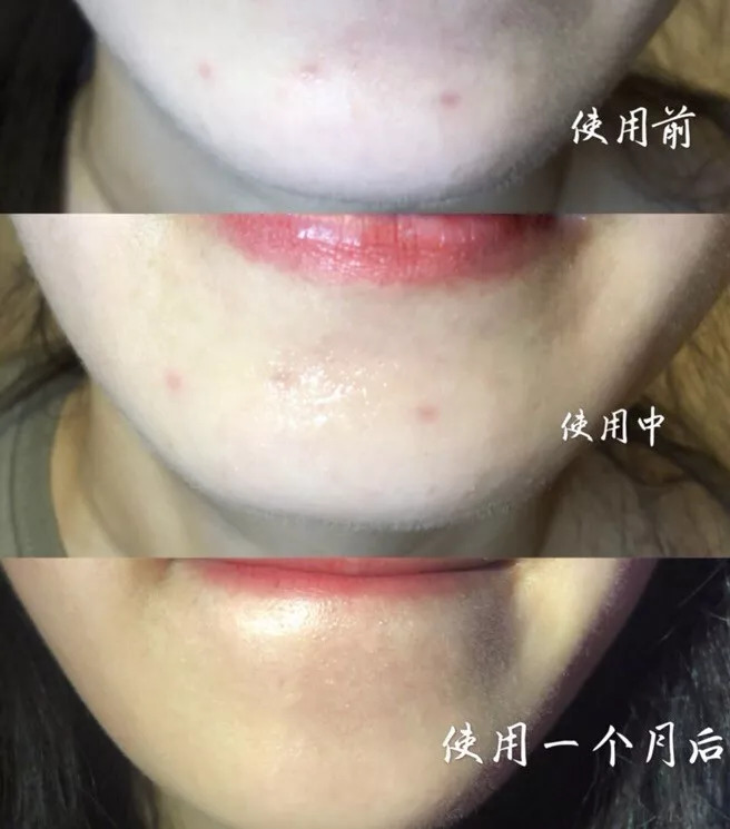 毛孔粗大痘印痘坑中医调理有用吗,痘坑痘印用冻干粉可以修复吗