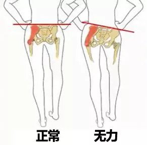 走路扭臀是什么原因,走路扭臀什么原因