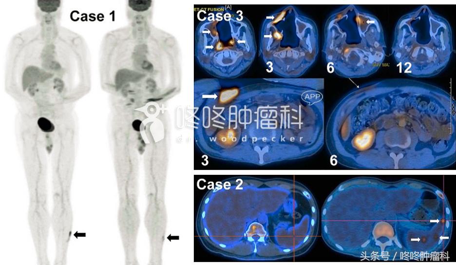pd-1治疗复发弥漫大b细胞淋巴瘤,pd-1治疗nkt淋巴瘤有效吗