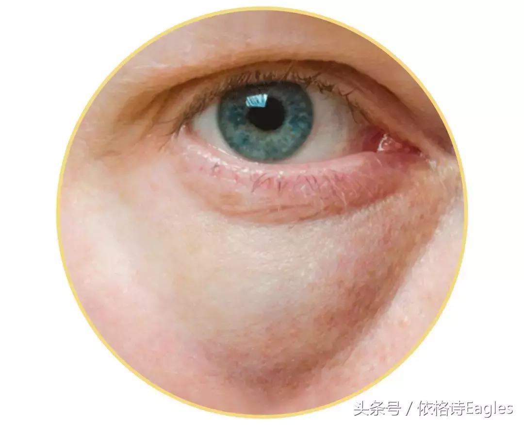 黑眼圈色素沉淀还有救吗,细纹黑眼圈用什么眼霜