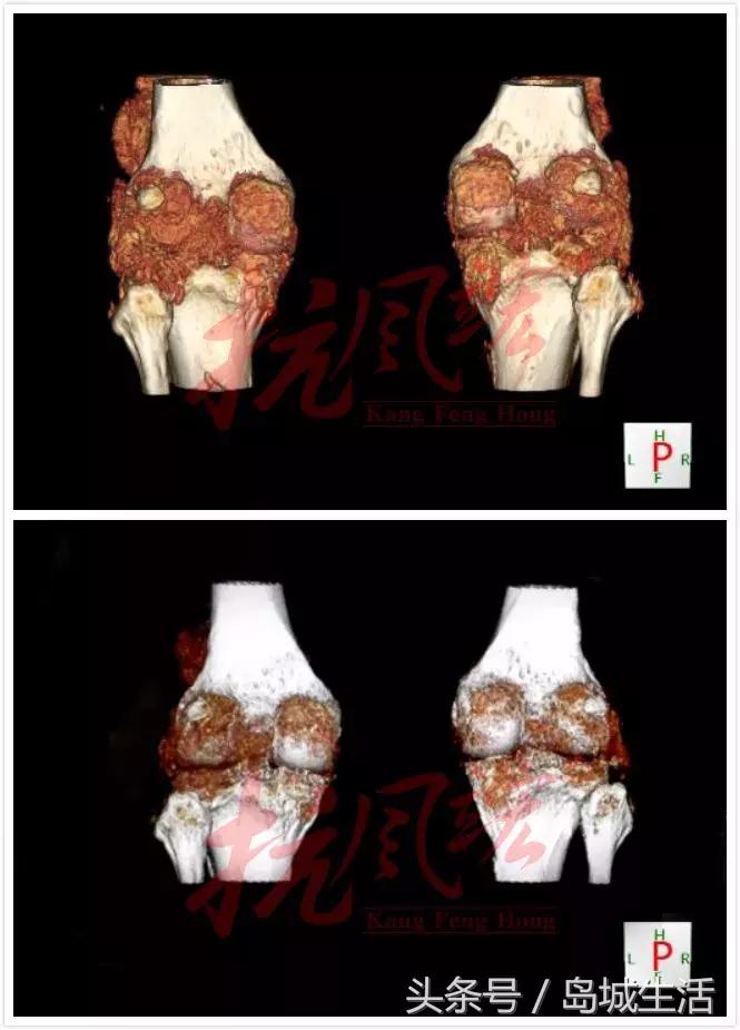 痛风久治不愈怎么办,痛风久治不愈就差在这一步上