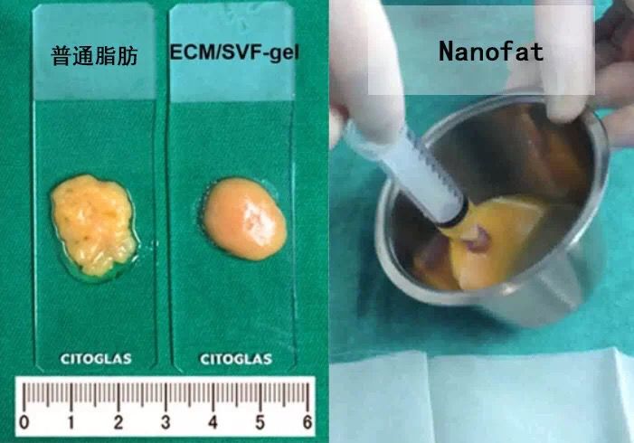 自体脂肪移植三个月后开始血供,自体脂肪填充和移植有什么区别