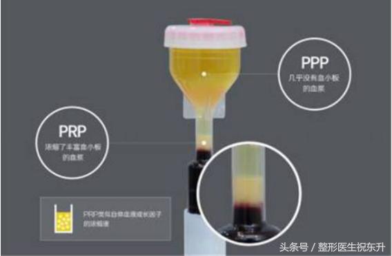 prp和自体脂肪哪个保持时间长点,prp填充和自体脂肪填充哪个好