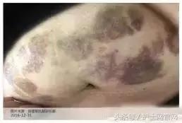 低分子肝素皮下注射后血肿,长期打低分子肝素导致的皮下硬结