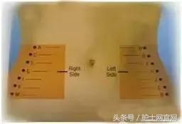 低分子肝素皮下注射后血肿,长期打低分子肝素导致的皮下硬结