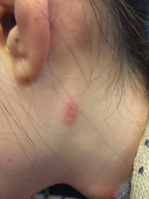 猫癣介绍,猫有猫癣摸一下会被传染吗