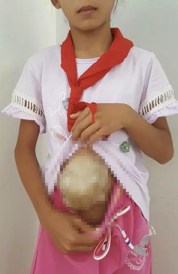 罕见!肝脏长出体外12年,被医生塞回少女身体内!