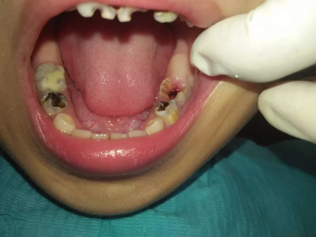 孩子蛀牙不会痛，医生为啥要杀死牙神经！你家娃中招了吗？