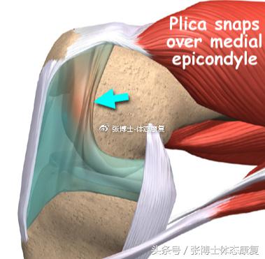 膝关节滑膜皱襞综合征锻炼,膝关节滑膜皱襞综合征怎么治