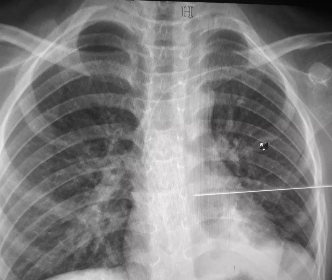 余杭区妇幼保健院另辟儿童PICC置管之路，减少小儿治疗痛苦！