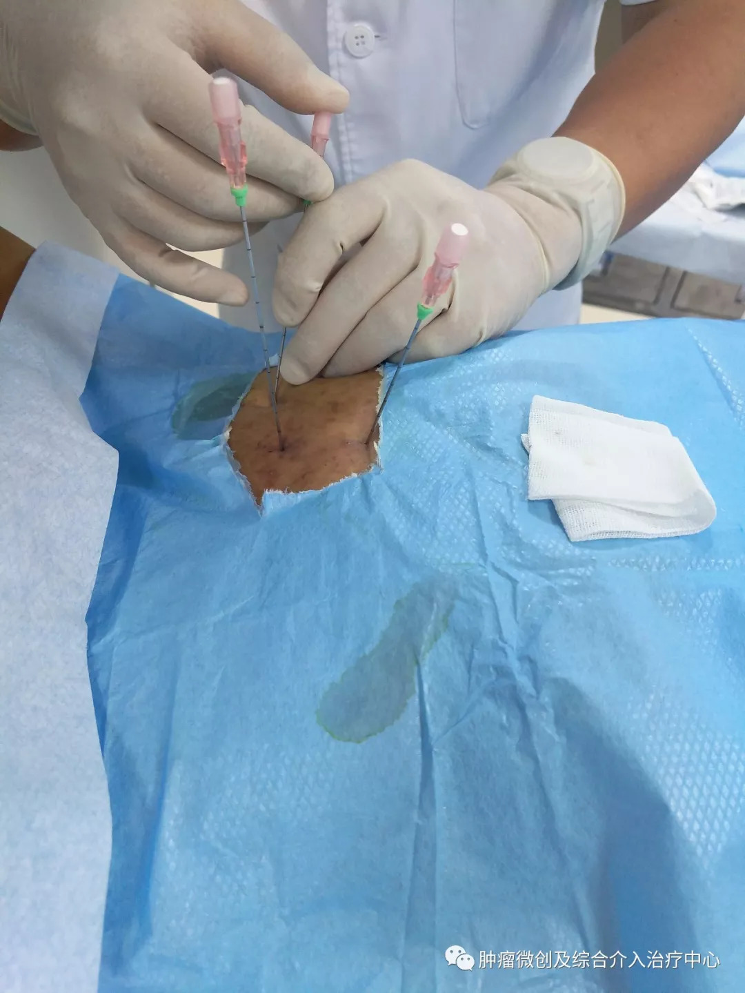 肺癌的诊断+综合介入治疗（穿刺活检+肿瘤血管栓塞+消融+碘125例子植入）—运城市第一医院肿瘤微创及综合介入科
