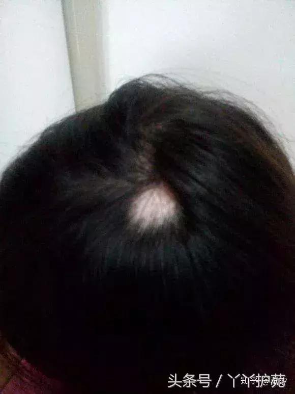 为什么脱发的人越来越年轻,为什么当代年轻人脱发越来越普遍