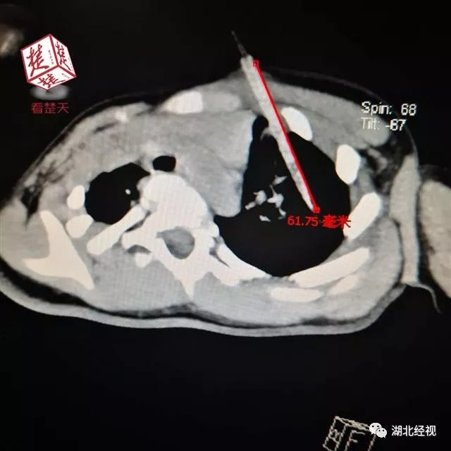 2岁孩子不小心把竹签穿喉咙,儿童用竹签戳到喉咙没有出血