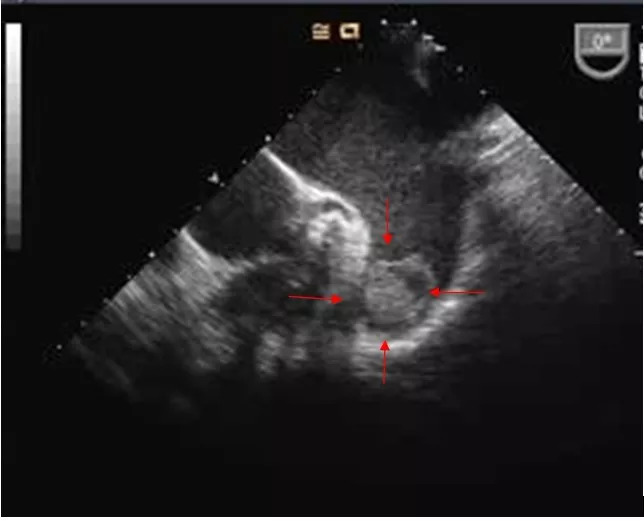 治房颤新技术叫什么,治房颤的应急中成药